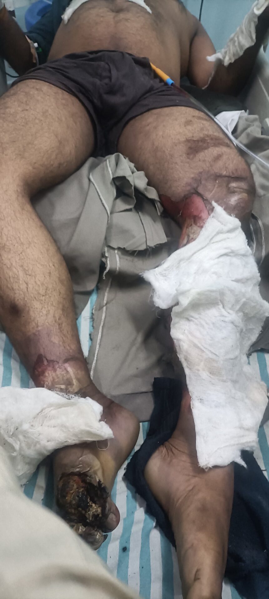 लाइन मैन के साथ बड़ा हादसा